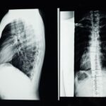 CT scan vs X-ray