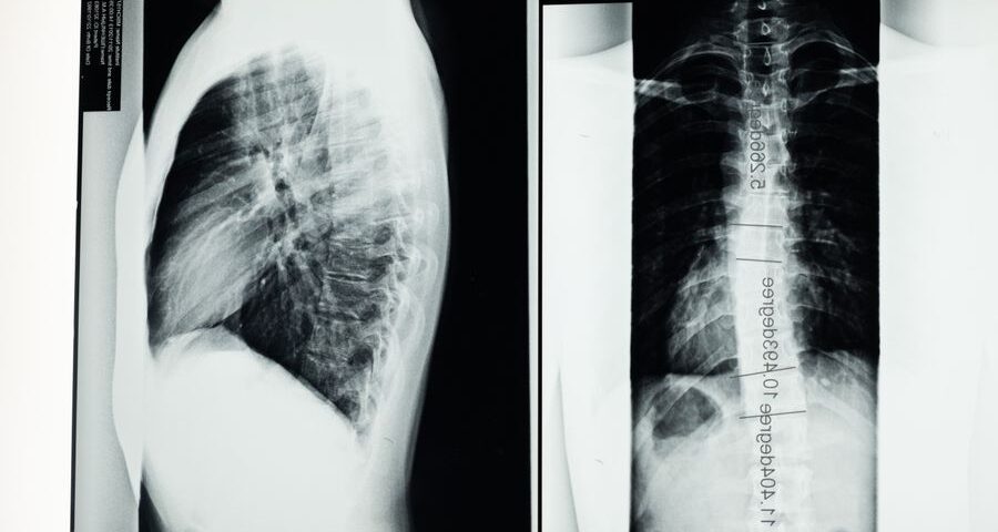 CT scan vs X-ray